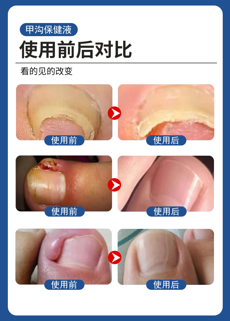 甲溝炎專用液有用嗎？使用前后對(duì)比